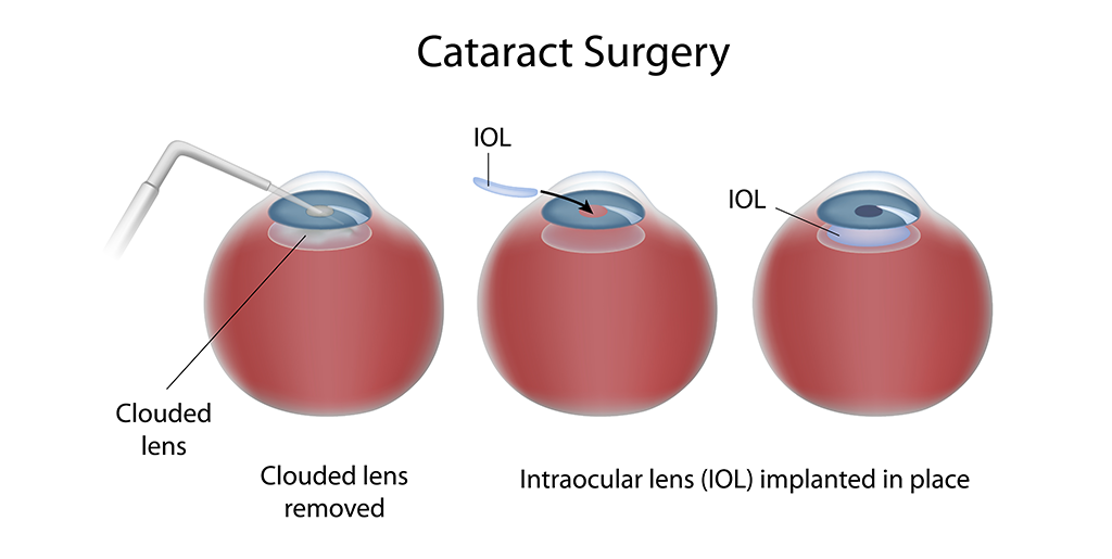 CatractSurgery