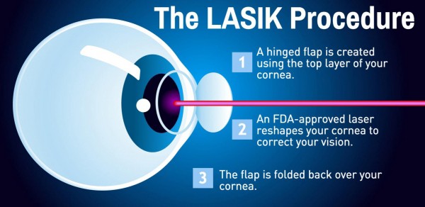 lasik